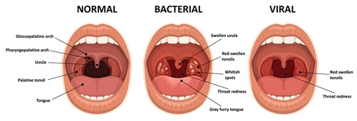 Tonsillitis Types Causes Symptoms Complications 52 OFF