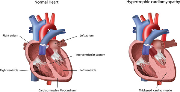 Test Your Cardiomyopathy ICD-10-CM Knowledge With a Quick Quiz : Quiz