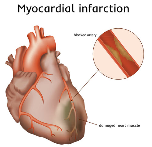 what-is-myocardial-infarction-neet-pg-medicine