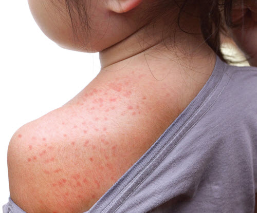 use-this-guide-to-code-pediatric-skin-rashes-icd-10-coding