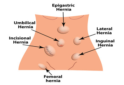Inguinal hernia repair Information