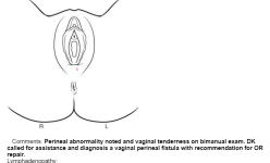 vaginal perineal fistula.PNG